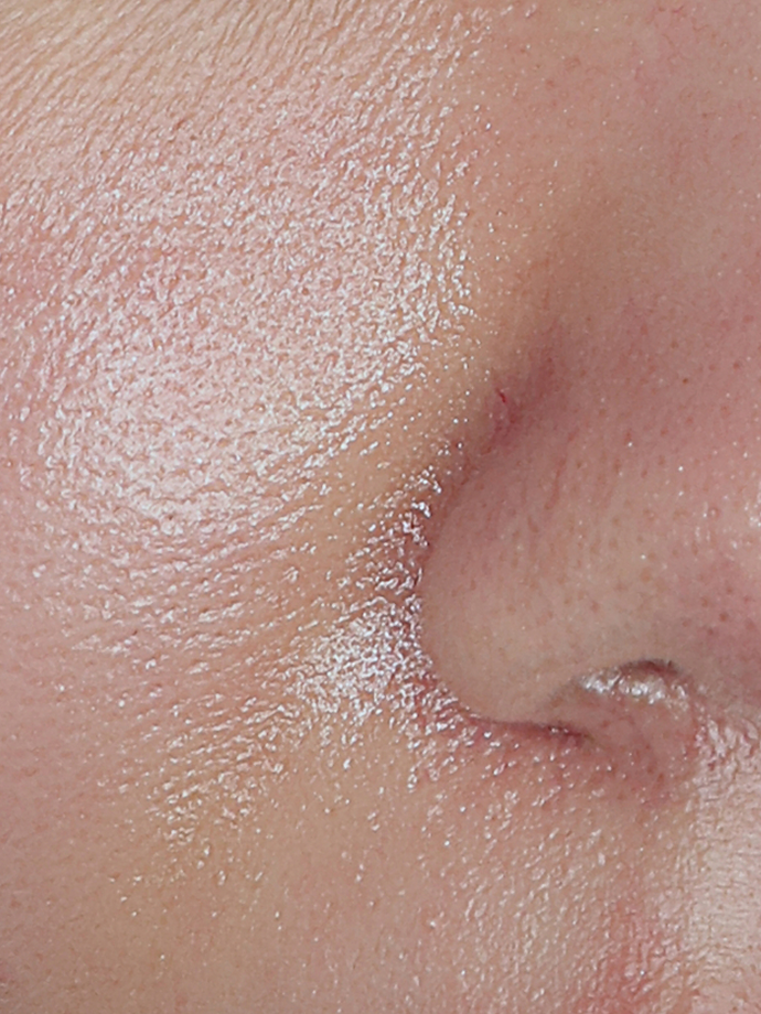 [30대 중반] 5회 시술 After