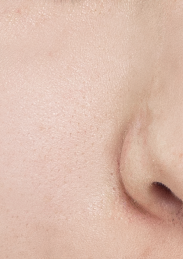 [30대 후반] 10회 시술 After