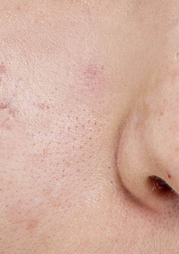 [30대 후반] 10회 시술 Before