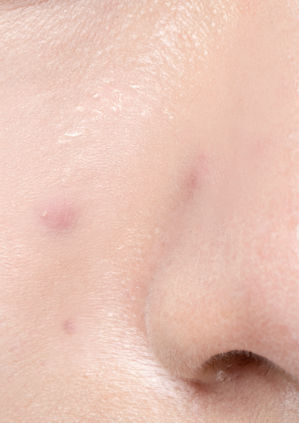 [20대 초반] 5회 시술 Before