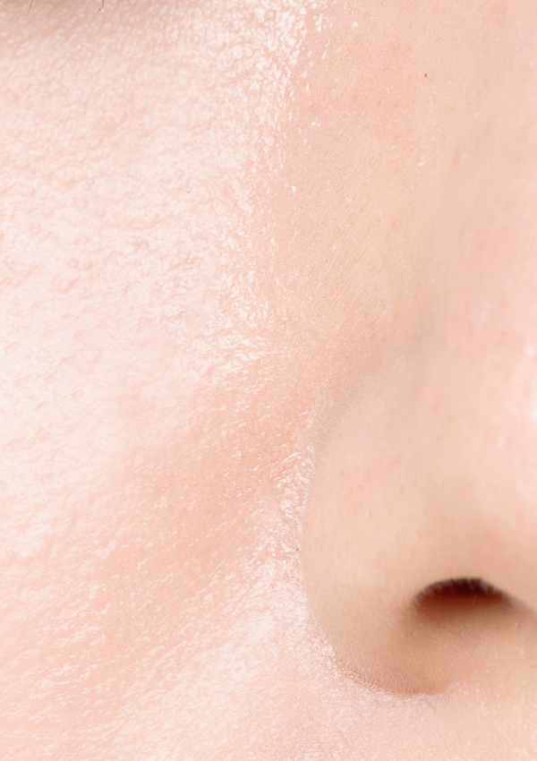 [20대 중반] 5회 시술 After