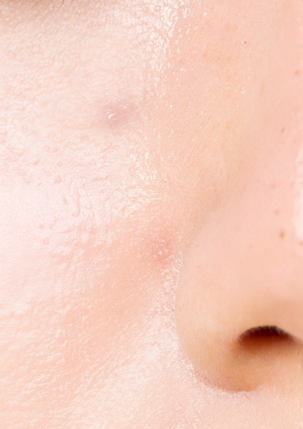 [20대 중반] 5회 시술 Before