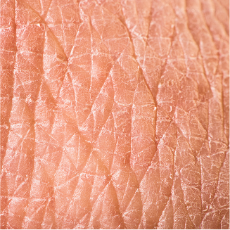 건조한/거친 피부