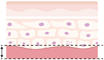 조직 - 재생층 (진피)